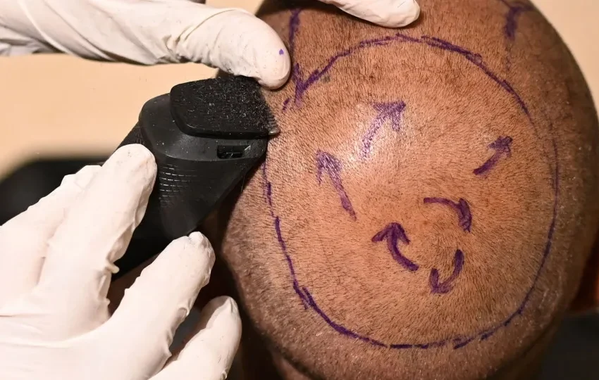  Policial morre após realizar transplante capilar; veja os riscos