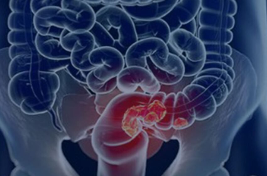  Pacientes com câncer colorretal são diagnosticados em estágio avançado