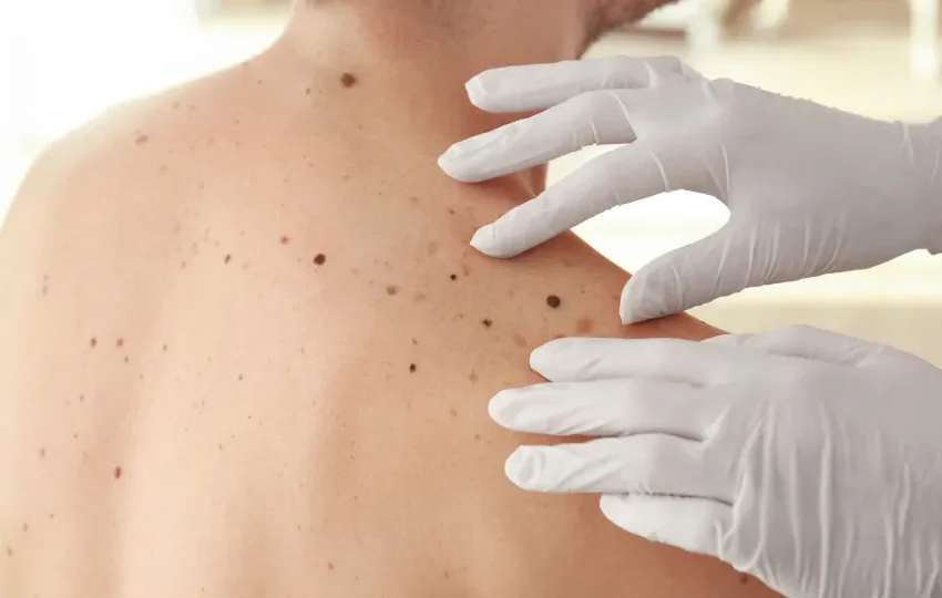  Casos de câncer de pele saltam de 4 mil para mais de 72 mil em 10 anos