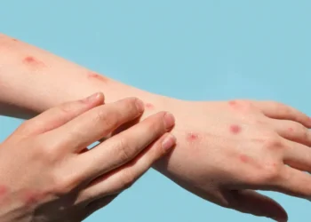 Brasil registra 48 casos de mpox nos primeiros meses de 2026