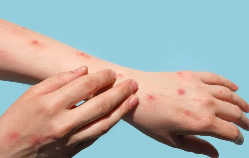  Brasil registra 48 casos de mpox nos primeiros meses de 2026